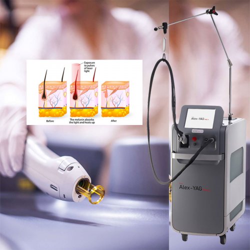 755nm alexandrite laser nd yag 1064nm laser hair removal beauty equipment